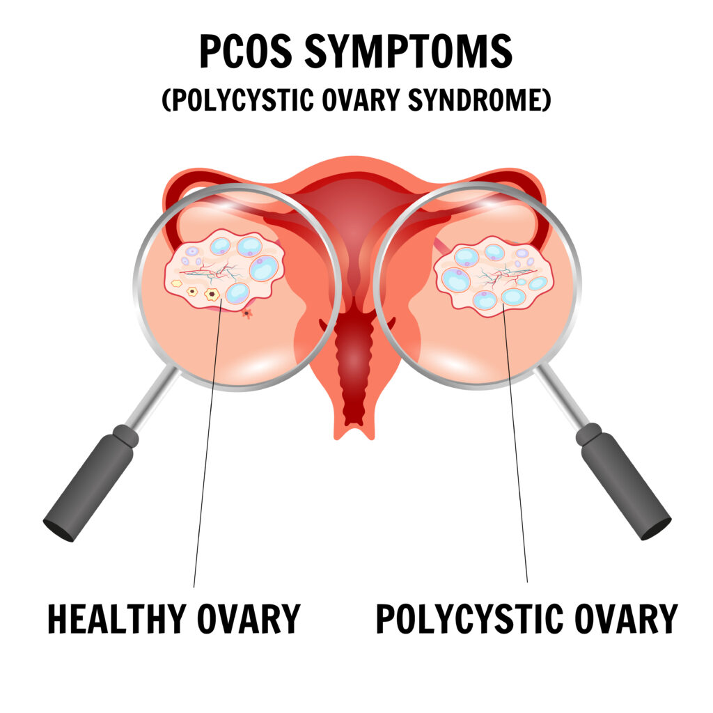 Polycystic Ovary Syndrome: A Comprehensive Overview